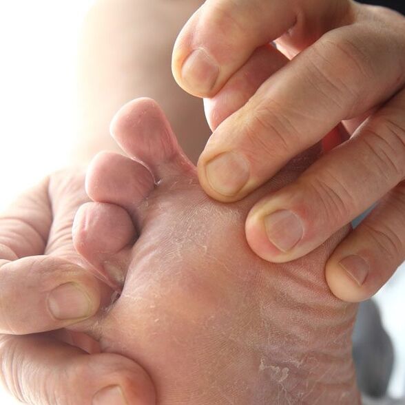 Il fungo colpisce la pelle tra le dita dei piedi