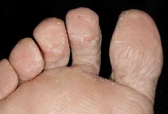 Manifestazioni di un'infezione fungina sui piedi