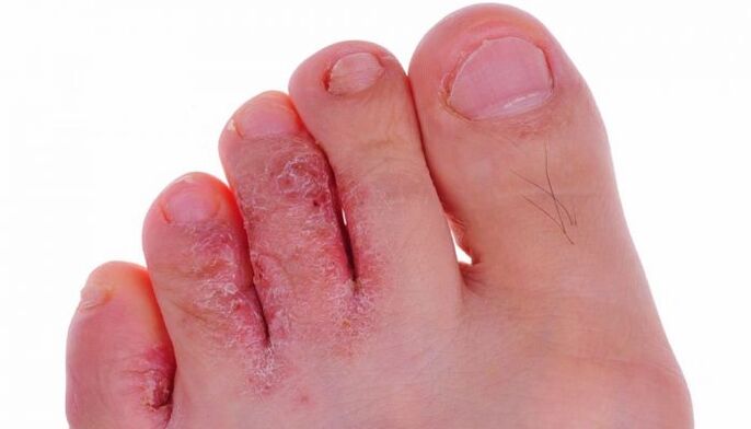 infezione fungina della pelle delle dita dei piedi