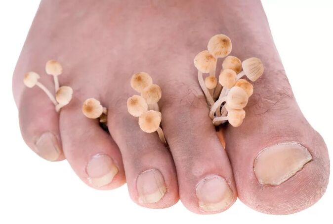 Il fungo dei piedi