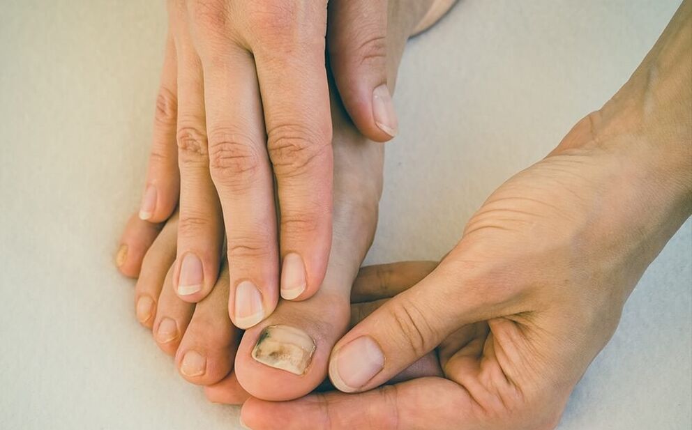 fungo dell'unghia del piede come trattare