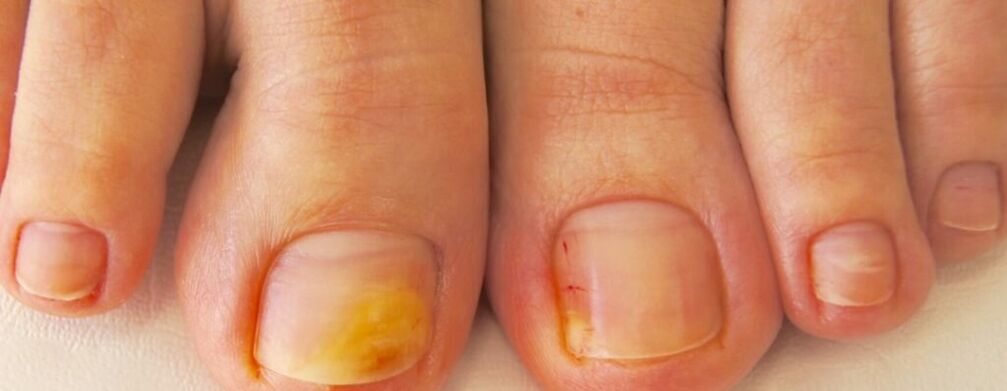 La fase iniziale dell'onicomicosi - ingiallimento delle unghie dei piedi