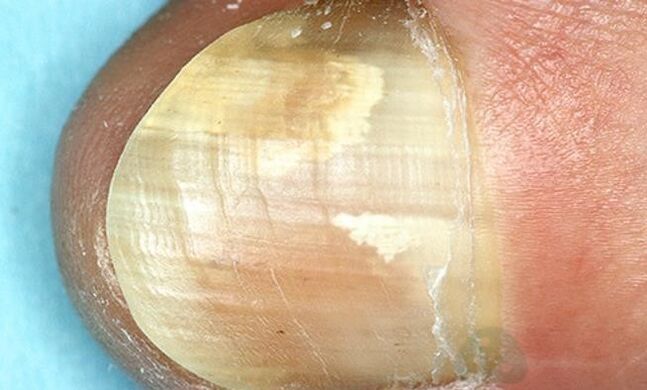 Trattamento dei funghi di punta con farmaci per azioni interne