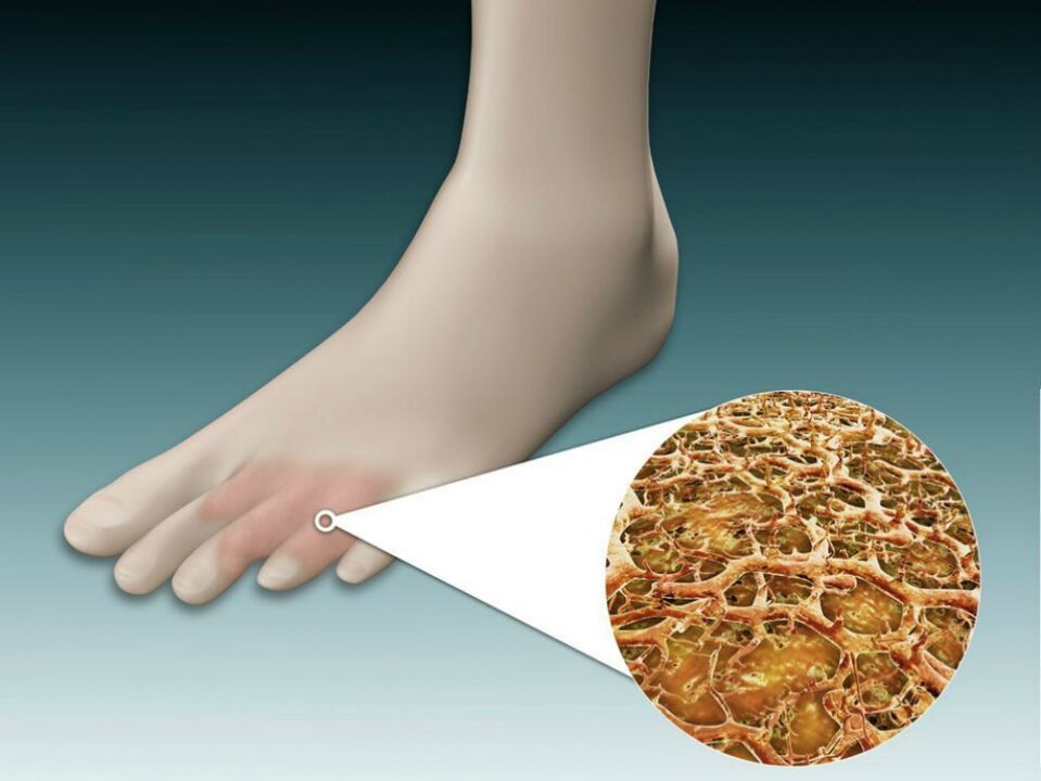 Arrossamento della pelle tra e vicino alle dita dei piedi con funghi intertriginosi