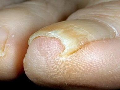 Comparsa di unghie dei piedi infette da funghi